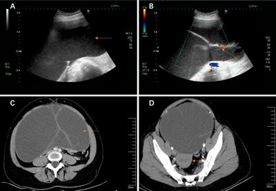 Giant Ovarian Cysts Treated by Single-Port Laparoscopic Surgery: A Case Series